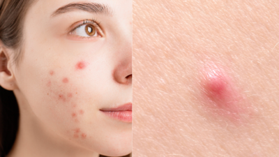 Difference between pimples and acne: How to heal them?